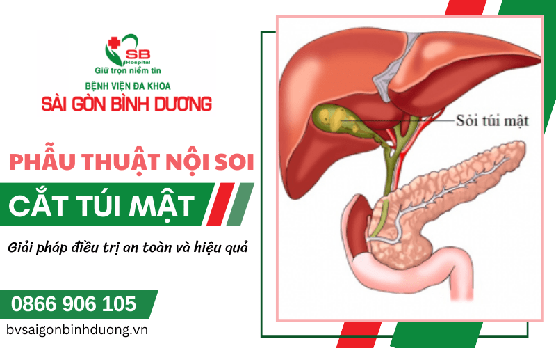 phẫu thuật nội soi cắt túi mật