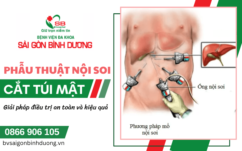 phẫu thuật nội soi cắt túi mật