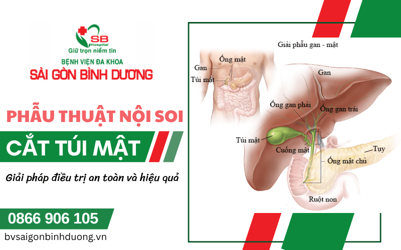 phẫu thuật nội soi cắt túi mật